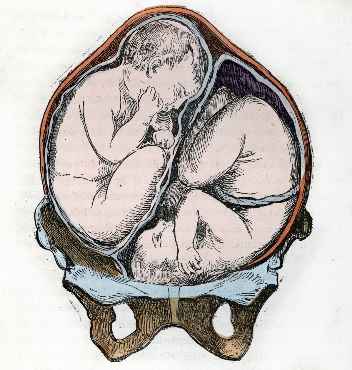 Representation of the good position of two fetuses during a gemellar pregnancy Engraving from “” La nature et l