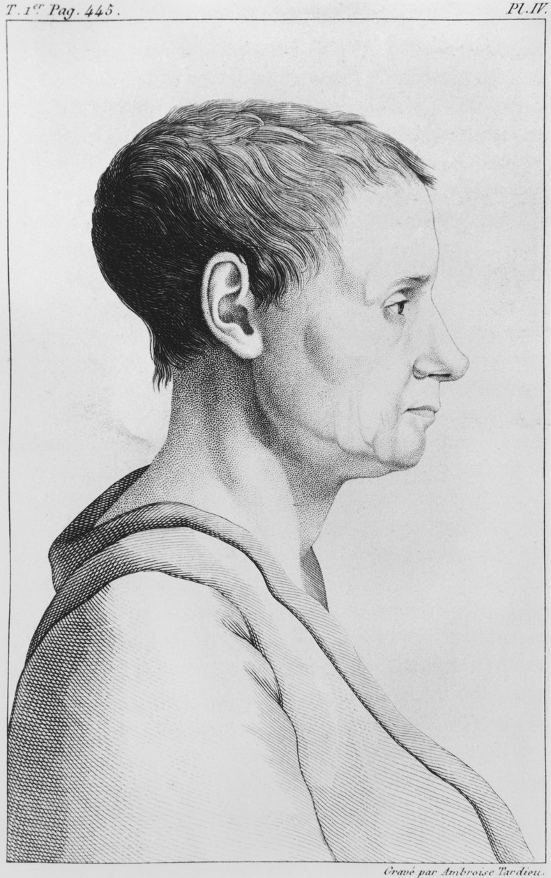 Theroigne de Mericourt、「エティエンヌエスキロール（1772-1840）プレートIV、1838年の「Des Maladies Mentales dans le rapport medical、hygienique et medico-legal」と見なされたイラスト 作： アンブロワーズ・タルデュー