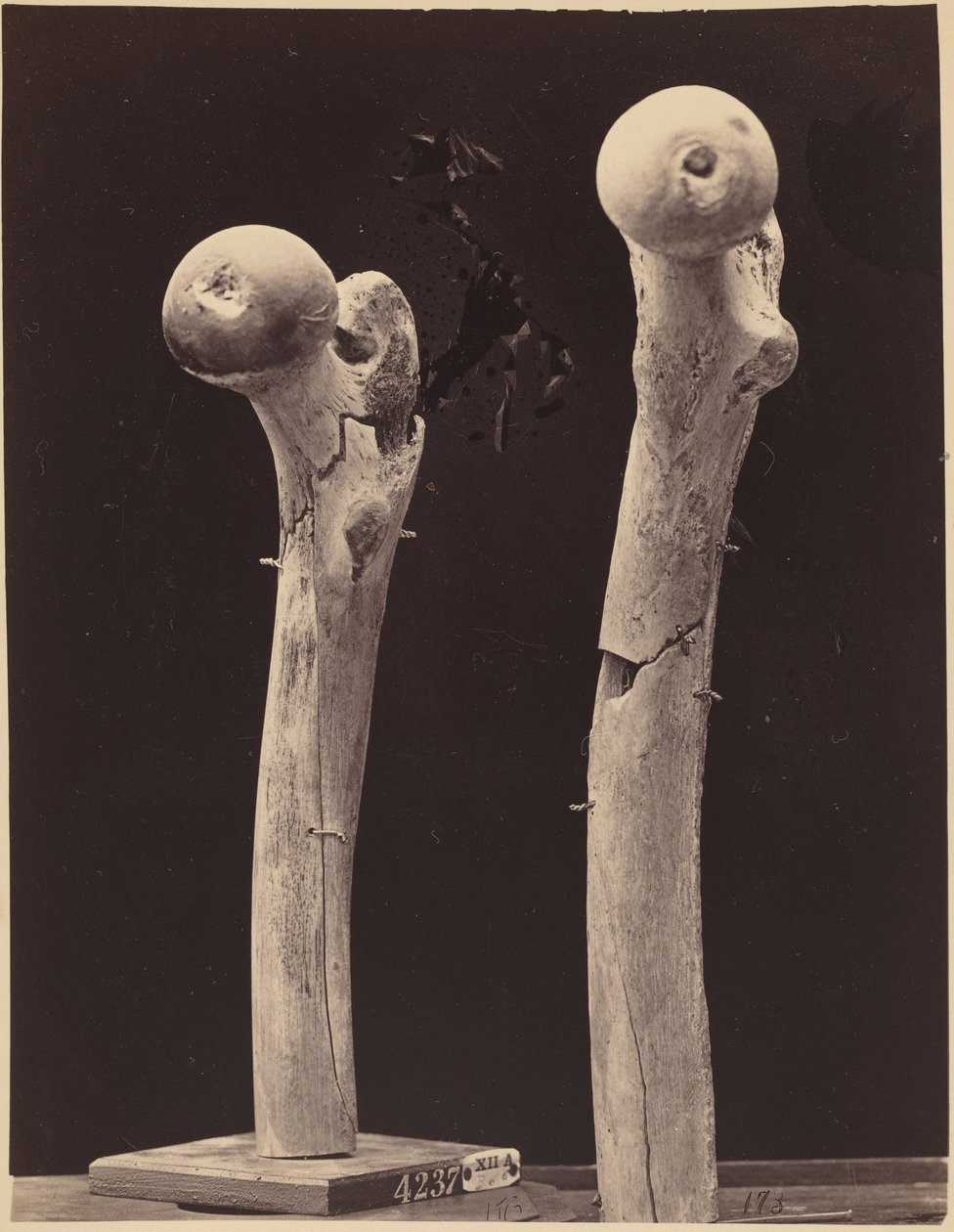 大腿骨銃創の標本、c.1867年（写真） 作： アメリカの写真家