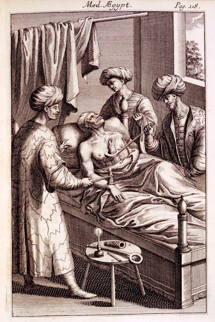 1745年のプロスペロアルピニによる医学エジプト人の灸のイラスト 作： アメリカの学校