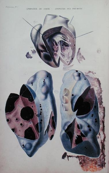 パリで出版されたJean Cruveilhier (1791-1874)の「Anatomie pathologique du corps humain」の図版で、心臓と肺の発作。 作： アントワーヌ・シャザル
