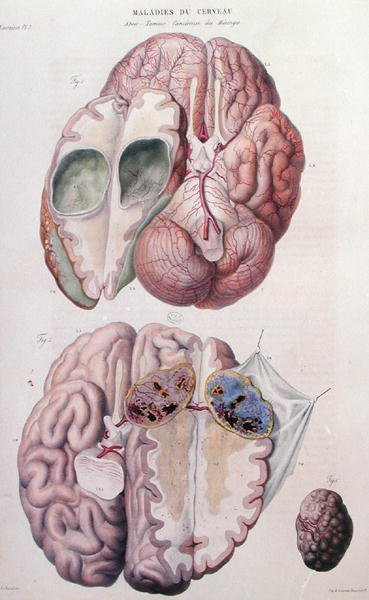 Jean Cruveilhier (1791-1874) 1828-42年の『Anatomie Pathologique du Corps Humain』より、脳の癌性腫瘍（彩色彫刻） 作： アントワーヌ・シャザル