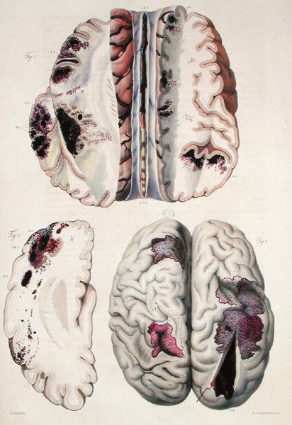 毛細血管性脳卒中、ジャン・クルヴェイリエ（1791-1874）1828-42年の「人間の病理解剖」より（彩色済み版画） 作： アントワーヌ・シャザル