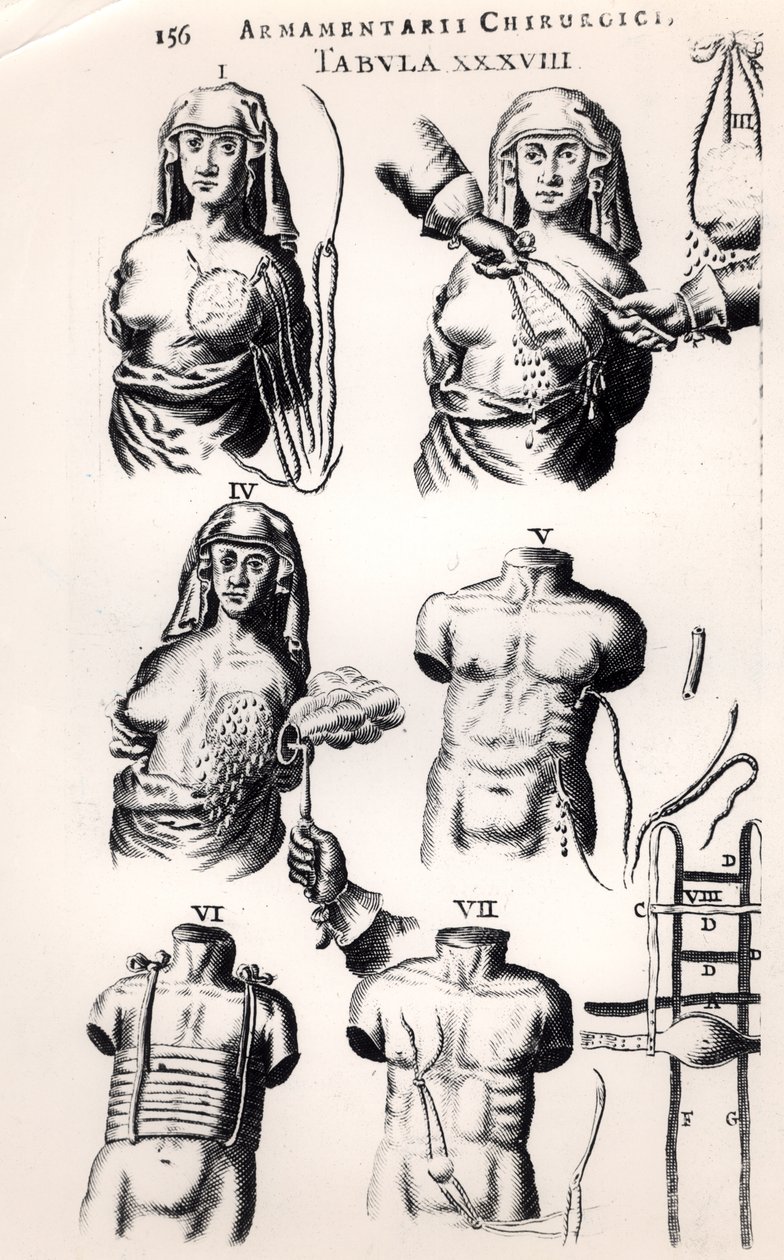 1672年にアムステルダムで出版されたJohannes Schultes（1595-1645）によるArmamentarii Chirurgiciによる乳がんの手術 作： オランダ語学校