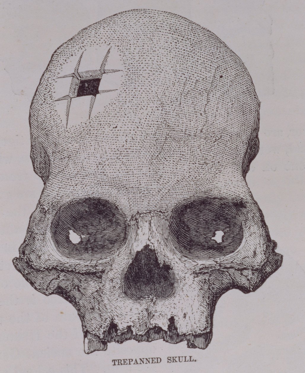 E. George Squierによる &39;Incas of the Land in the Land in the Land in the Incas&39;（パブ）のTrepanned Skull。 1878年 作： 英語学校