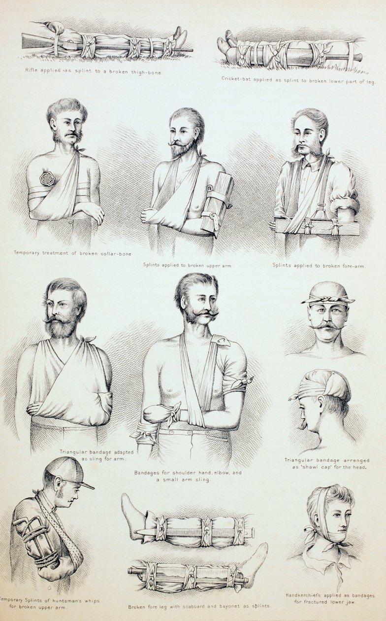 骨折の一時的な治療、1890年頃 作： 英語学校