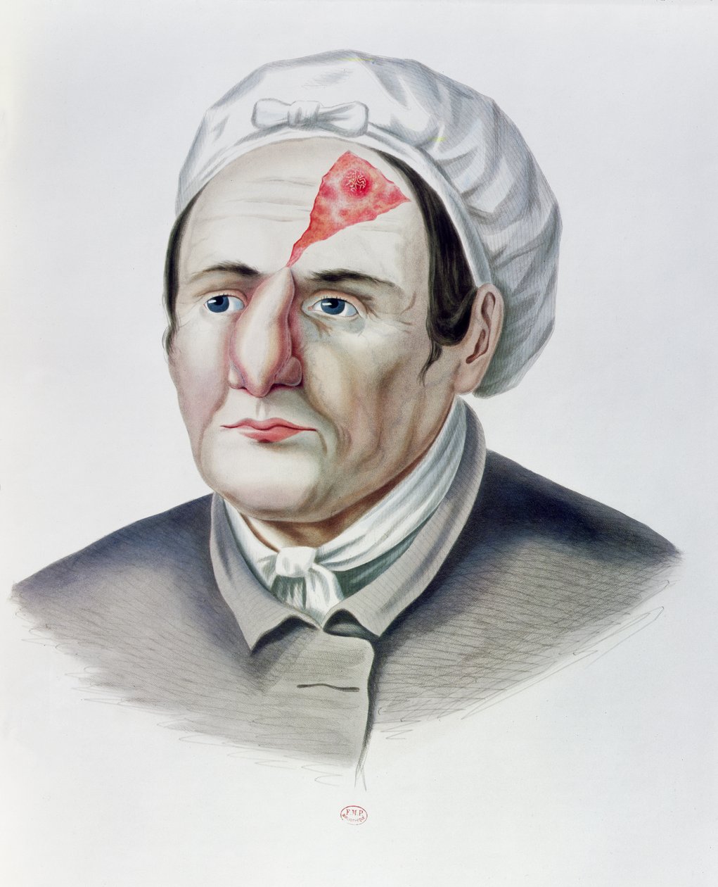 皮膚移植手術後、1856年、パリ、アレクサンダーオベール作のSelecta Praxis Medico-Chirurgica作 作： フランス語学校
