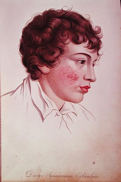 ジャン・ルイ・アリベール男爵（1768-1837）の「皮膚の病変に関する記述」からのドライパッチ 作： フランス語学校