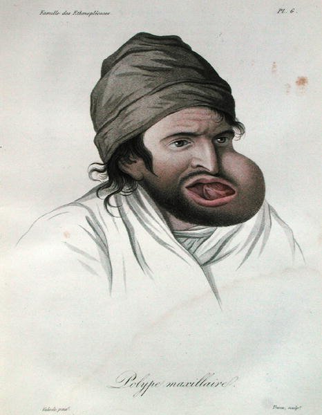 上顎のポリープ、Baron Jean Louis Alibert（1768-1837）の著書より 1817年（彩色彫刻） 作： フランス語学校
