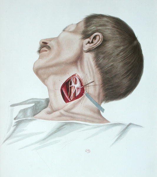 動脈瘤の手術（パリ、Alexander Auvert著「Selecta Praxis Medico-Chirurgica」より 作： フランス語学校