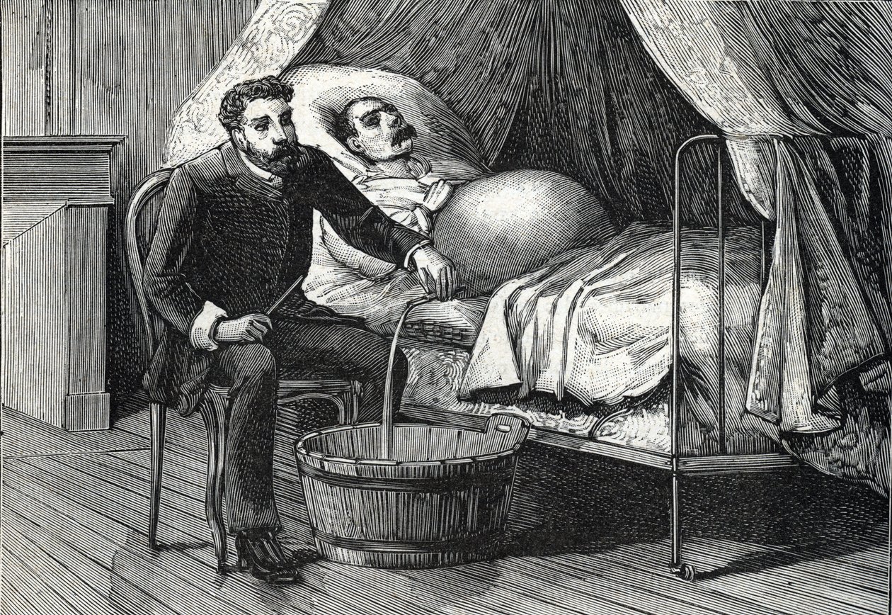 進行した肝硬変の患者、穿刺を行う医師（彫刻）1888年 作： フランス語学校