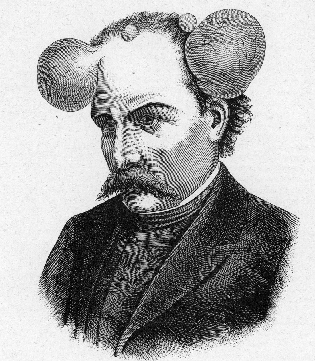 虫眼鏡をかけた人物の表現、頭皮の嚢胞（彫刻 作： フランス語学校