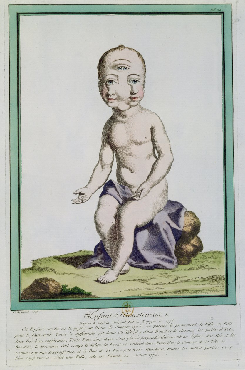 変形した頭を持つ子供、「レエカルトデラネイチャー」、パリ、1775年 作： ジュヌヴィエーヴ・ルノー・ド・ナンギス