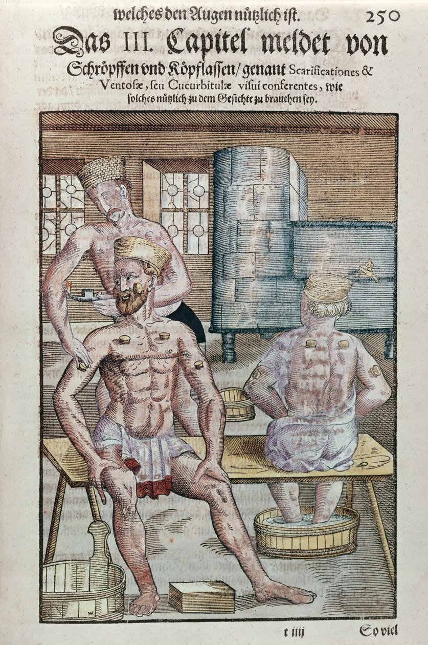 カッピング、1583年にドレスデンで出版されたGeorg Bartisch（1535-1636）によるOphthalmodouleiaから（色木版画） 作： ドイツ語学校