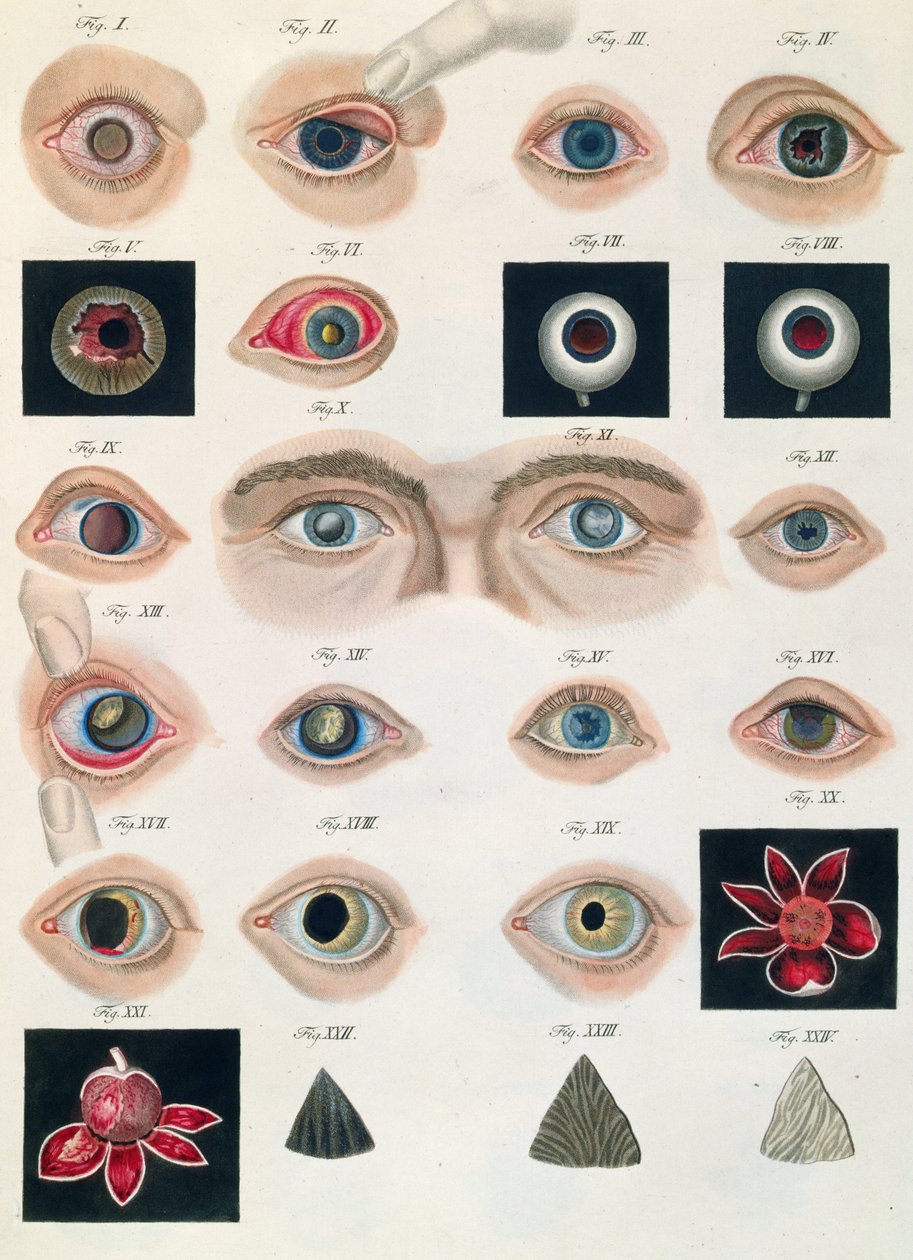 フリードリッヒ・アウグスト・フォン・アンモン（1799-1861）1838による、先天性の眼の異常の説明、病気の臨床的表現および人間の目の盲目な欠陥から 作： ドイツ語学校