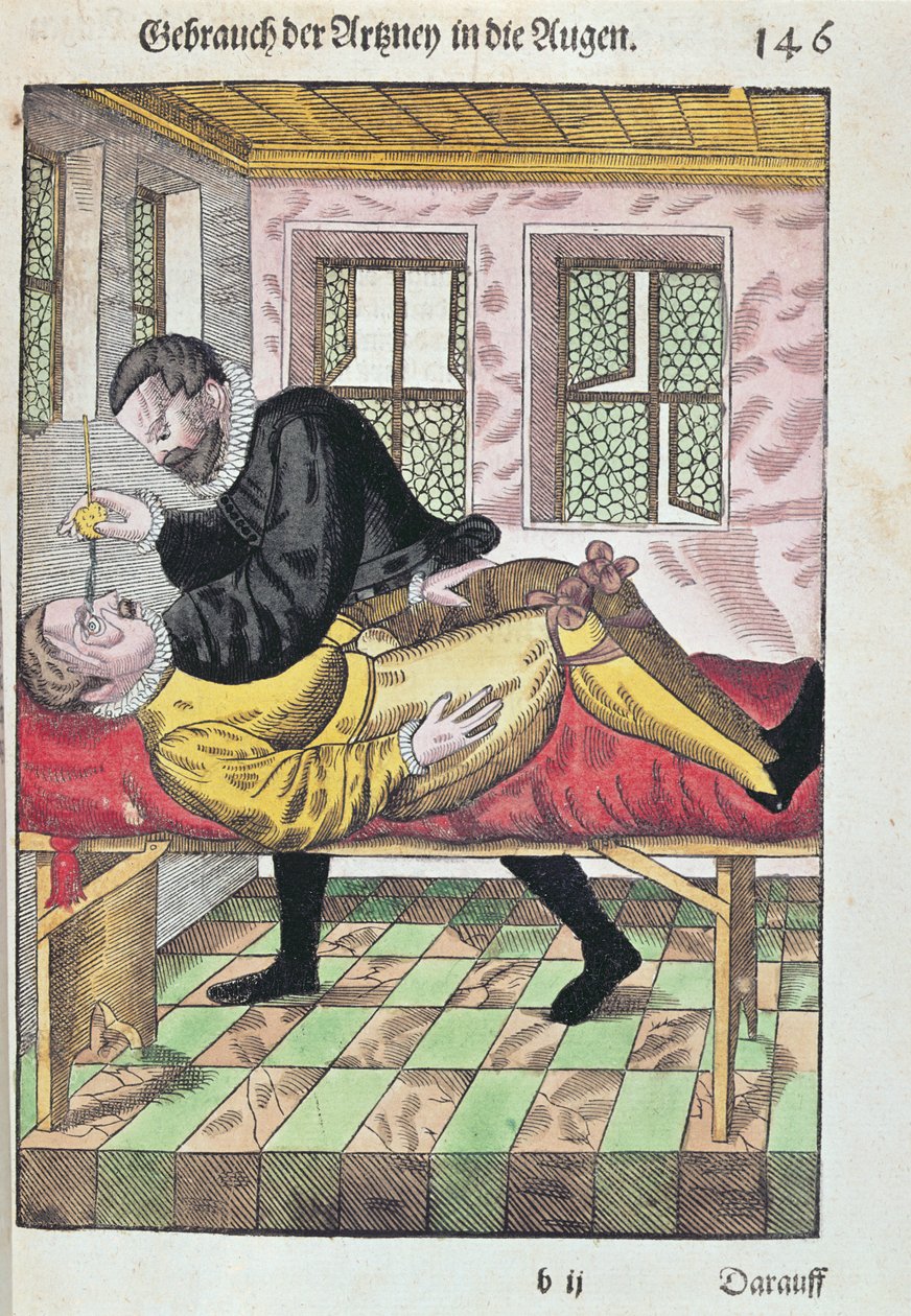 眼科手術、眼科、Georg Bartisch（1535-1636）、1583年にドレスデンで出版（色木版画） 作： ドイツ語学校