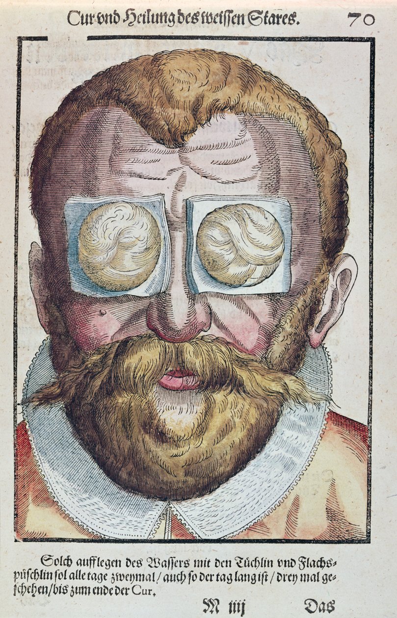 眼の状態の治療、1583年にドレスデンで出版されたGeorg Bartisch（1535-1636）によるOphthalmodouleiaから（カラー木版画） 作： ドイツ語学校