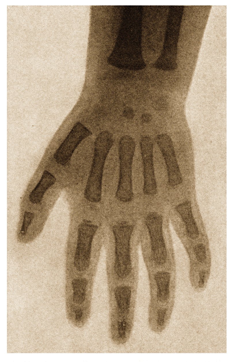 子供の手のX線c.1890 作： ドイツ語学校