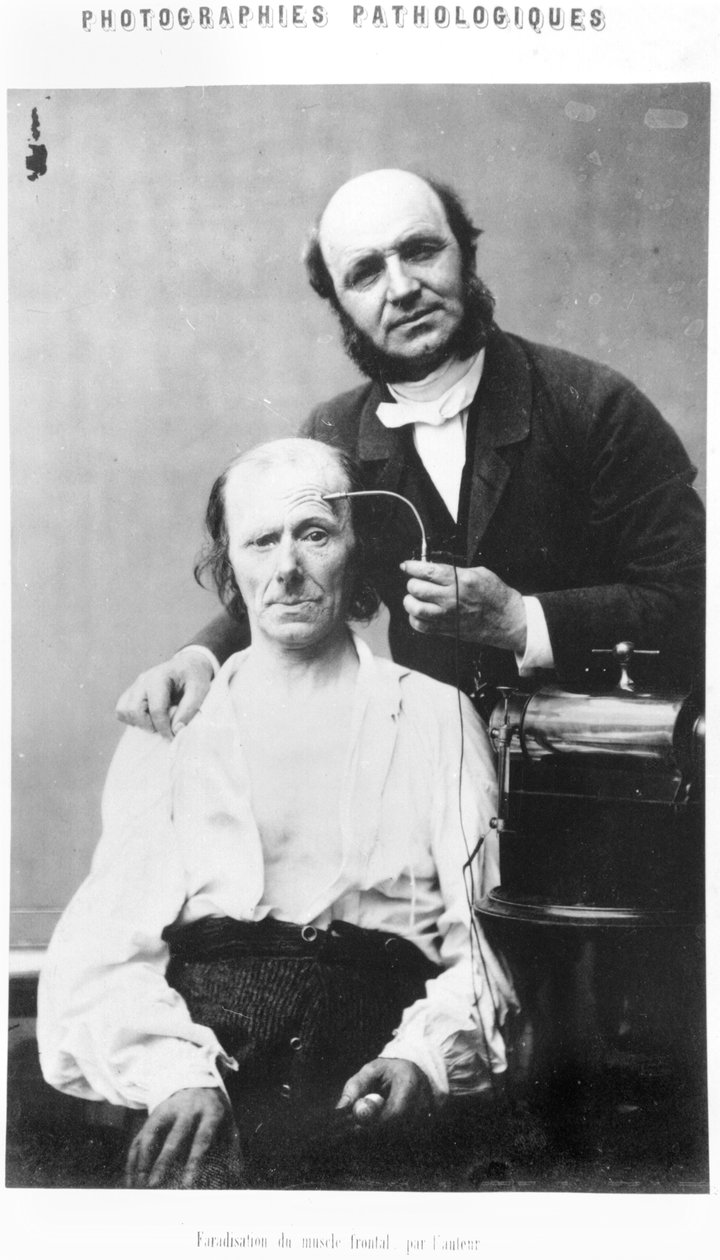 1862年に公開された、デュシェンヌドブローニュの「Album de photographies pathologiques」からの前頭筋のファラデー化、パリ 作： ギヨーム・ベンジャミン・アルマン・デュシェンヌ・ド・ブローニュ