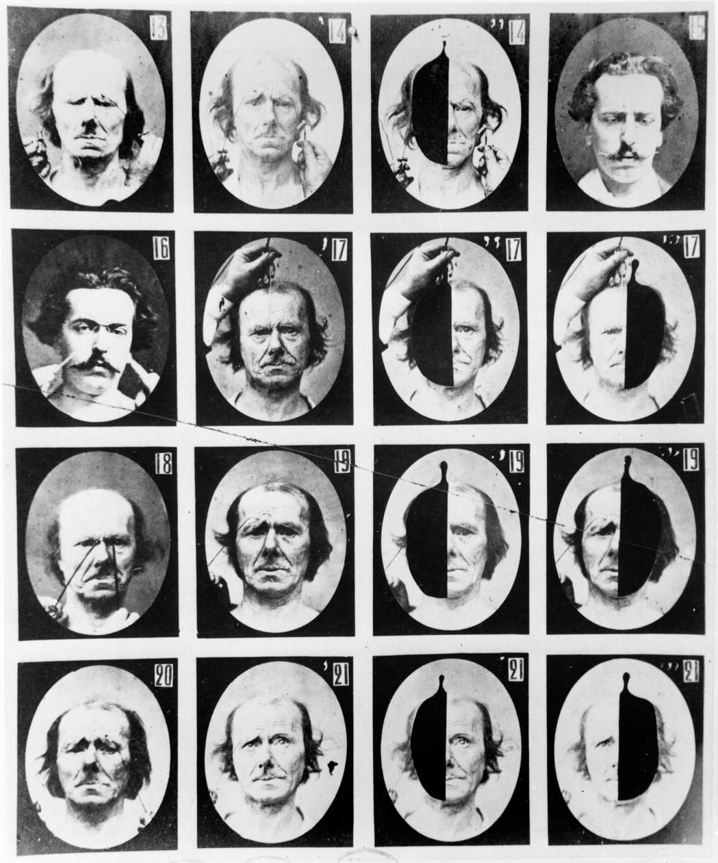 1876年パリ発行のDuchenne de Boulogneによる「Mechanisme de la Physionomie humaine ou analyze electrophysiologique des passions」からの生理学的研究 作： ギヨーム・ベンジャミン・アルマン・デュシェンヌ・ド・ブローニュ
