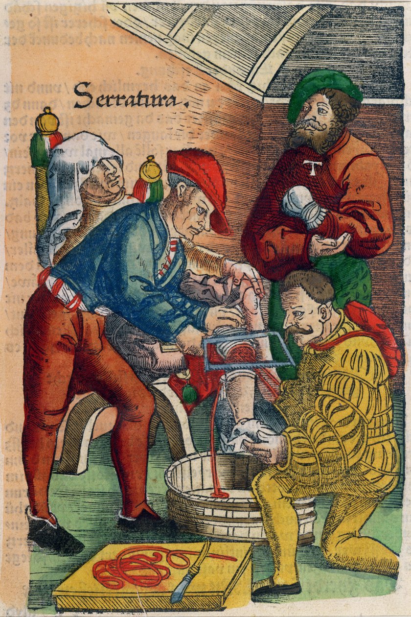 切断、ハンスフォンゲルスドルフの「フェルトブッフデアヴンダルツニー」のイラスト、c.1540（カラー木版画） 作： ハンスまたはヨハネス・ウルリッヒ・ウェヒトリン