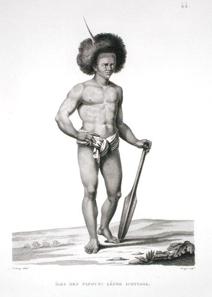 パプア諸島。ルイ・クロード・ドゥソールセス・ド・フレシネ（1779-1842）の「世界旅行（1817-20年）」よりハンセン病患者、フォルジェの彫刻、1822-24年に出版（リトグラフ）。 作： ジャック・エティエンヌ・ヴィクトール (後) アラゴ