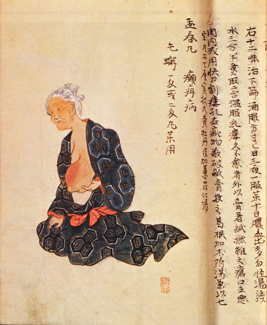 花岡誠秀（1760-1836）が1804年に全身麻酔下で行った乳がんの最初の外科的治療 作： 日本語学校