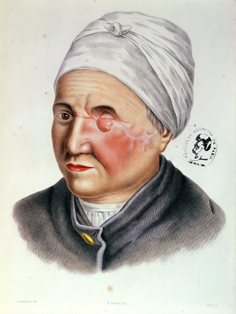アントワーヌジョベールドランバル（1799-1867）パリ、1849年のTraite de Chirurgie Plastiqueのイラスト 作： 画家ビルダー