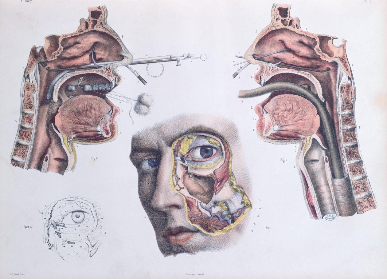 鼻の手術、ジャンバティストマルクブールジュリー（1797-1849）1866-67による「Traite Complet de l&39;Anatomie de l&39;Homme」のプレート 作： ニコラ・アンリ・ジェイコブ