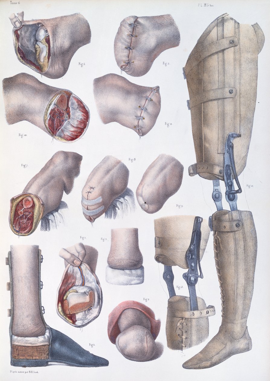 切断および補綴、ジャン・バティスト・マルク・ブールジェリー（1797-1849）1866-67による「Traite Complet de l&39;Anatomie de l&39;Homme」のプレート 作： ニコラ・アンリ・ジェイコブ