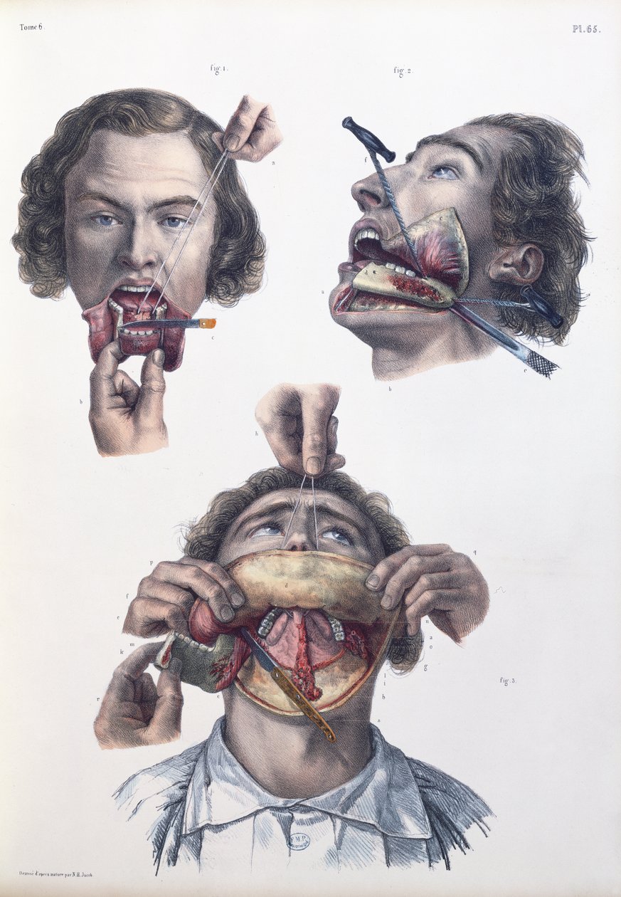 下顎の手術、ジャン・バティストマルクブールジェリー（1797〜1849）、1866〜67年の「Traite Complet de l&39;Anatomie de l&39;Homme」のプレート 作： ニコラ・アンリ・ジェイコブ