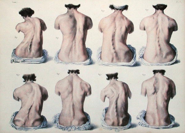 脊椎の変形、Jean-Baptiste Marc Bourgery (1797-1849) 1866-67年の「Traite Complet de l