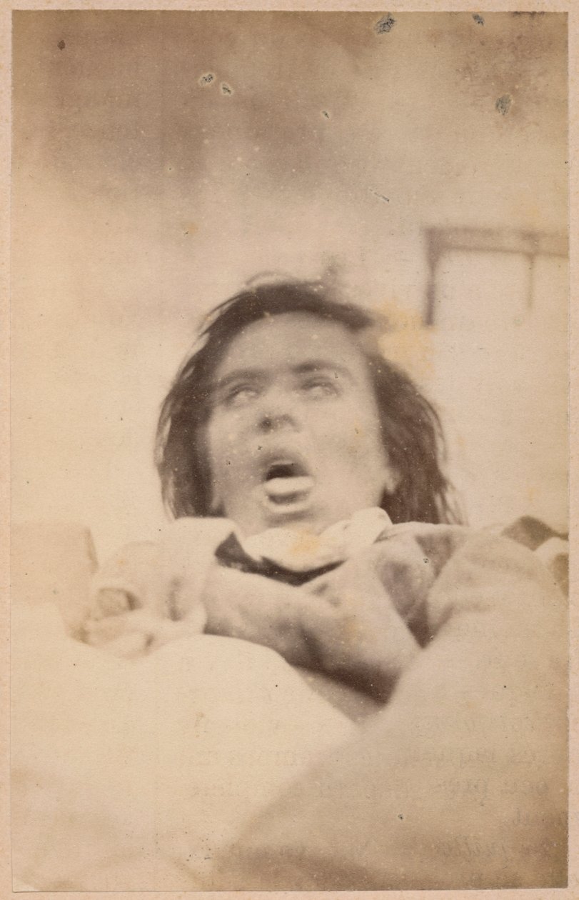 ヒステリーてんかん、幻覚、苦痛、プレートXXIX、「Iconographie Photographique de La Salpetriere」、BournevilleおよびP. Regnard、パリ、1876年（アルブメンプリント） 作： ポール・レナード