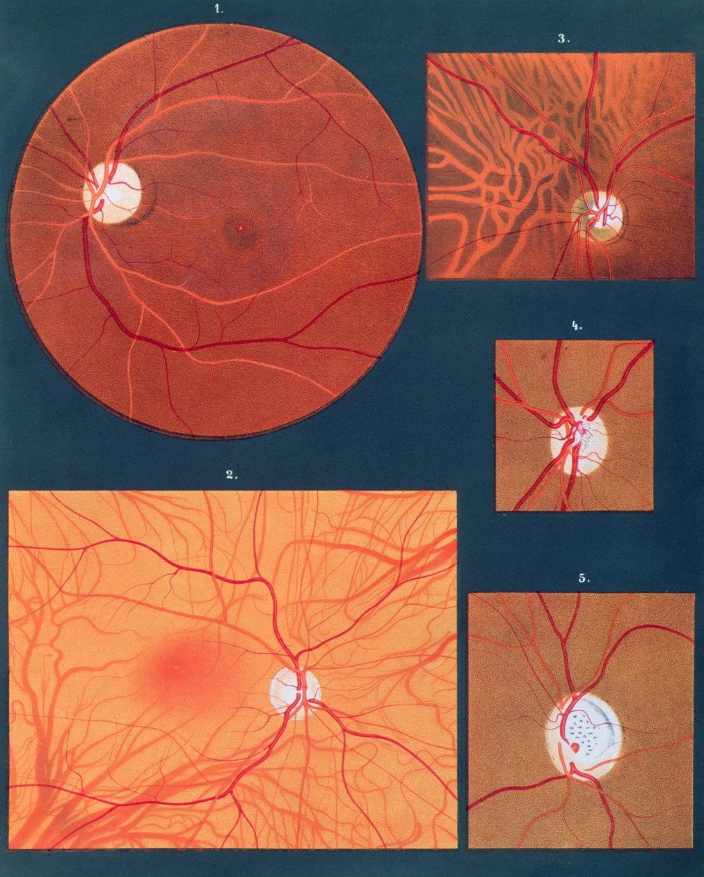 1870年にパリで発行されたAtlas of Ophthalmoscopyの顕微鏡で見た目（chromolitho） 作： リチャード・リーブライヒ