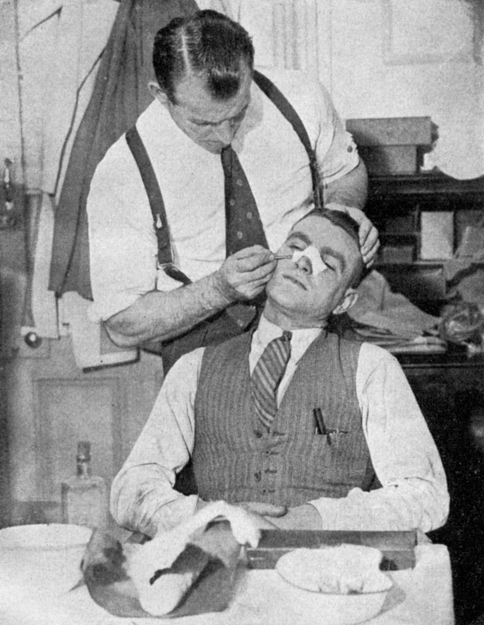 イングランドのキャプテン、エディハプグッドは、1934年のイタリアとの試合後に鼻骨折の治療を受けました。 作： 話題の報道機関