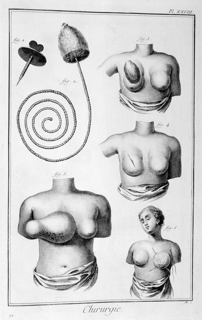 乳房手術、1751-1777 作： 不明