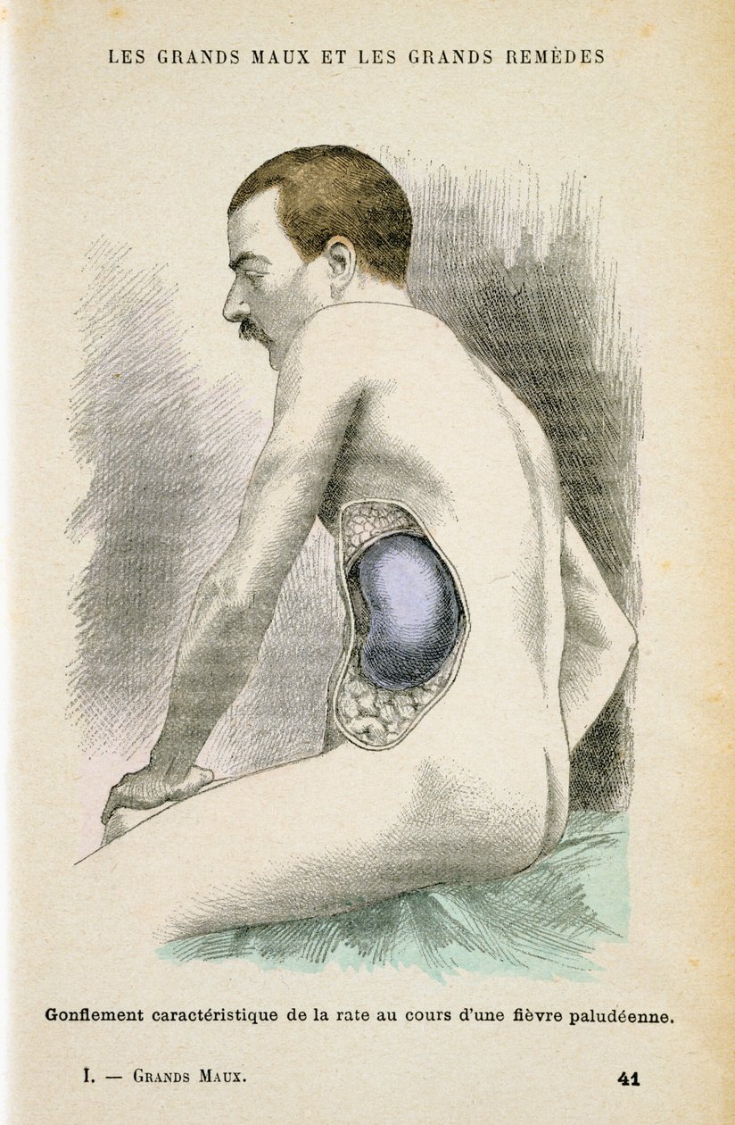 マラリア患者の典型的な肥大した脾臓、c1890 作： 不明