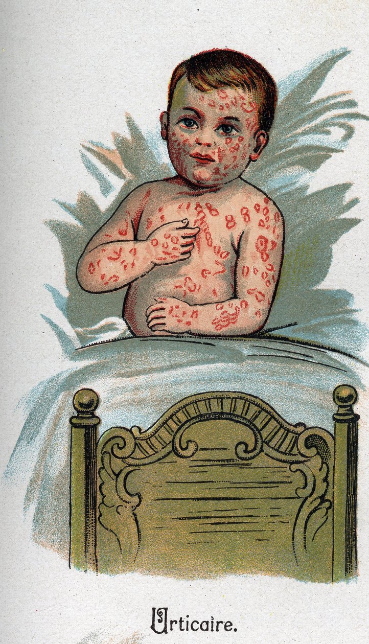 子供の病気のことじんましん。F.E.Bilzの "The New Natural Medicine "にて。 作： 無名の画家
