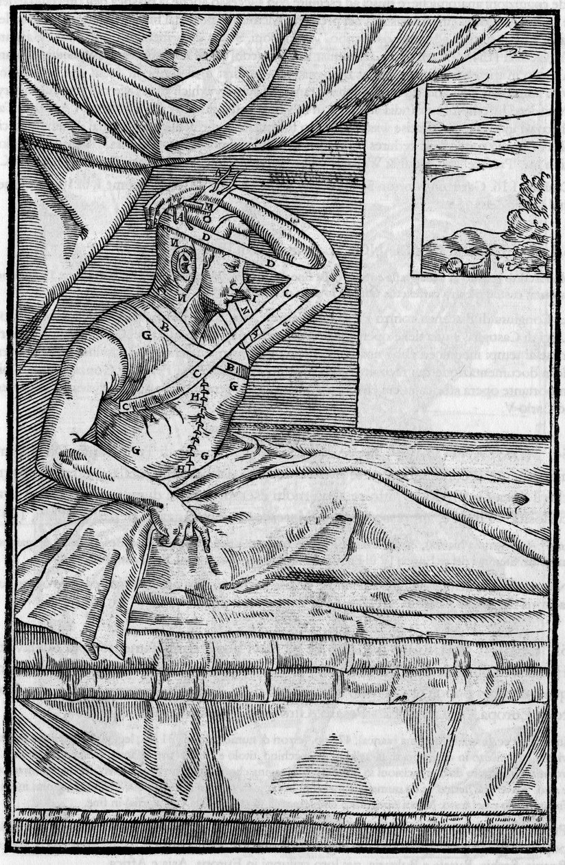 鼻の手術。De curtorum chirurgia per insitionem "の鼻の再建手術。ベニス 作： 無名の画家