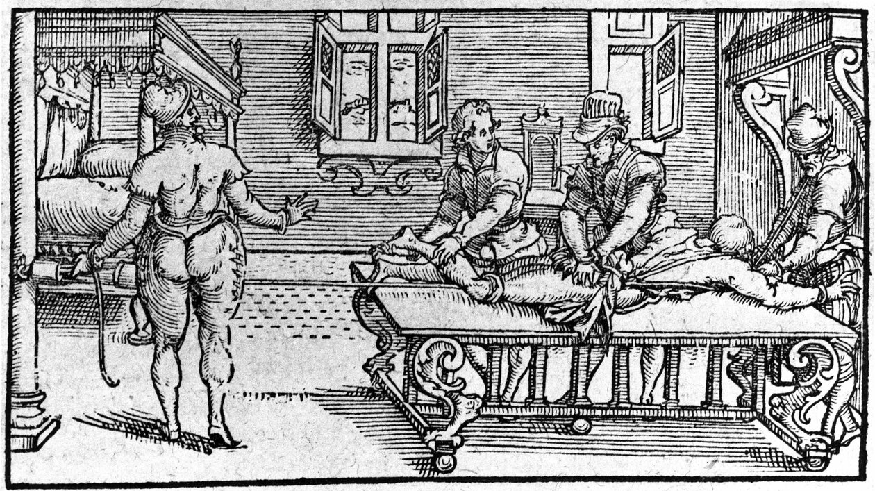 脱臼の整復（1560年頃、Ambroise Paréの「Traité Médical」より）。 作： 無名の画家