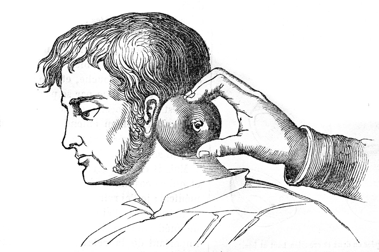 Saignee locales - リンゴを使ったヒルの塗布 - 1852年の "La Santo Universelle - Medical Guide for Families "に掲載された彫刻。 作： 無名の画家