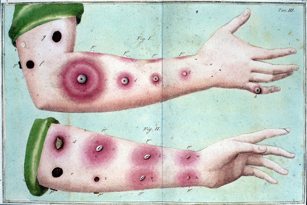 皮膚に膿疱が発生する天然痘疾患の症状。ミラノのLuigi Saccoによる "Vaccination Treat "の医療用プレート 作： 無名の画家