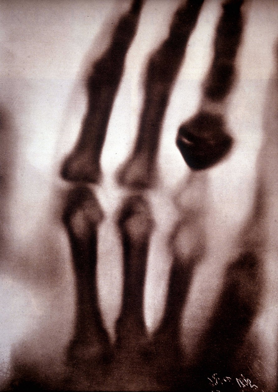 レントゲン線（Rontgen）またはX線 最初の写真：レントゲンの妻の手。22/12/1895. 作： 無名の画家