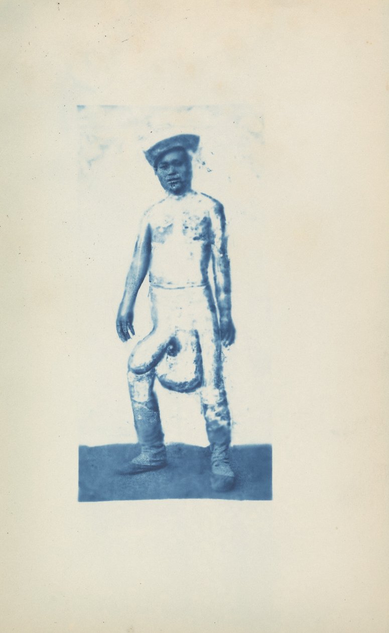 象皮病,c.1870年代（写真） 作： 未知の写真家