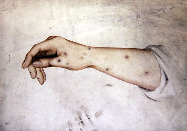 皮膚病の前腕部の習作 1850年頃 （紙に水彩画） 作： ウィリアム・ラヴァー