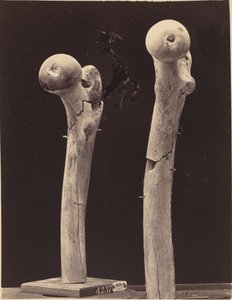 大腿骨の銃創骨折の標本 作： American 19th Century