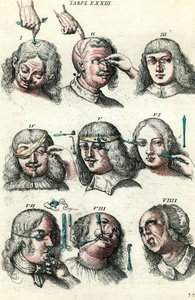 18世紀の外科手術。目と顔のトレパネーションと手術。ロレンツォ・ハイスターの「Institutionis chirurgicae」に掲載された版画 作： Anonymous Anonymous