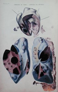 パリで出版されたJean Cruveilhier (1791-1874)の「Anatomie pathologique du corps humain」の図版で、心臓と肺の発作。 作： Antoine Chazal