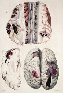 毛細血管性脳卒中、ジャン・クルヴェイリエ（1791-1874）1828-42年の「人間の病理解剖」より（彩色済み版画） 作： Antoine Chazal