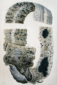 Jean Cruveilhier（1791-1874）1828-42年の「Anatomie Pathologique du Corps Humain」より腸の病気（彩色彫刻） 作： Antoine Chazal